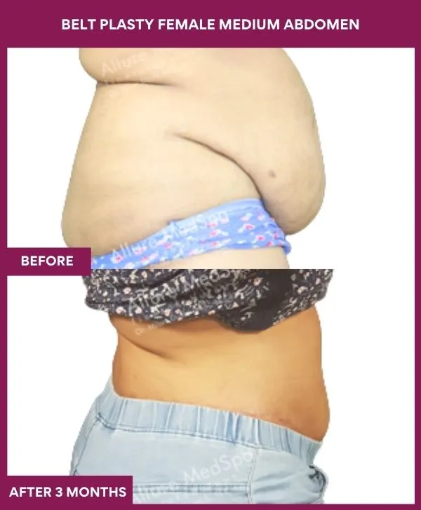 female-belt-lipectomy-before-after-results-mumbai-india-patient04-side-right