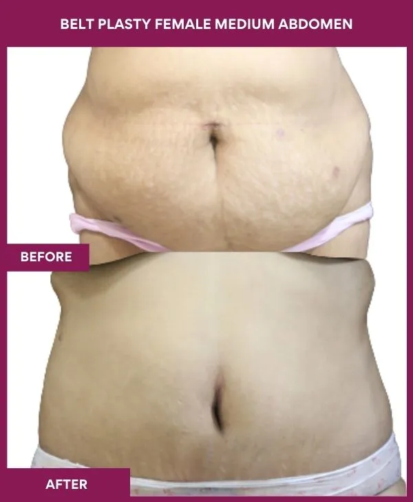 female-belt-lipectomy-before-after-results-mumbai-india-patient05-front