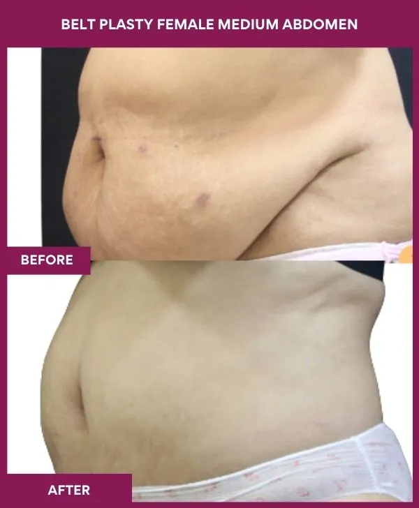 female-belt-lipectomy-before-after-results-mumbai-india-patient05-side-left