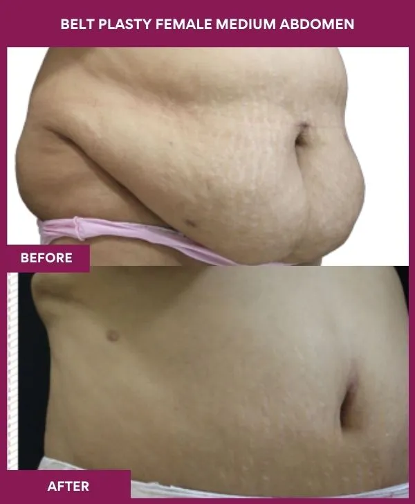 female-belt-lipectomy-before-after-results-mumbai-india-patient05-side-right