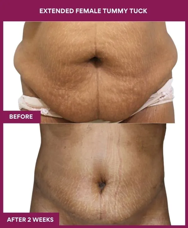 female-extended-tummy-tuck-before-after-results-mumbai-india-patient01-front