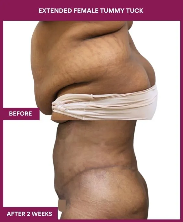 female-extended-tummy-tuck-before-after-results-mumbai-india-patient01-side-left