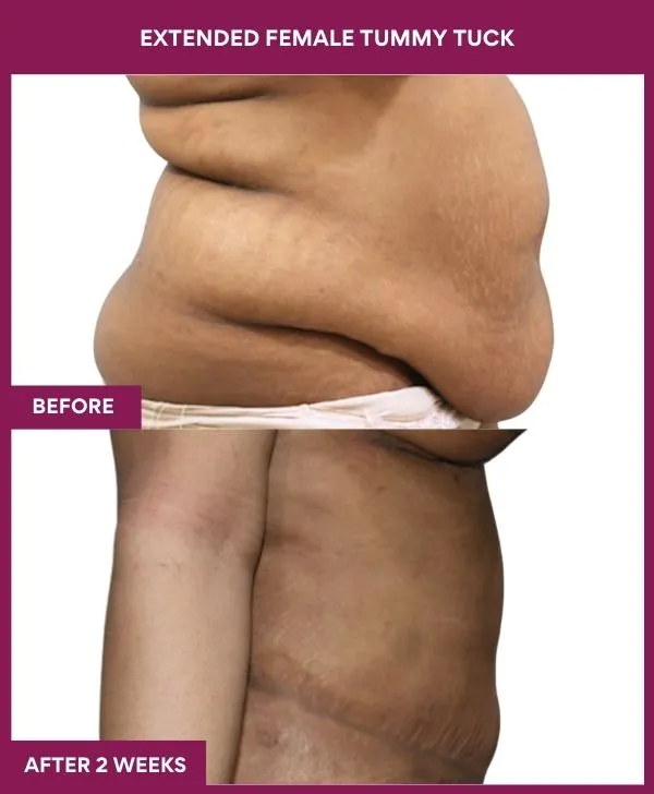 female-extended-tummy-tuck-before-after-results-mumbai-india-patient01-side-right