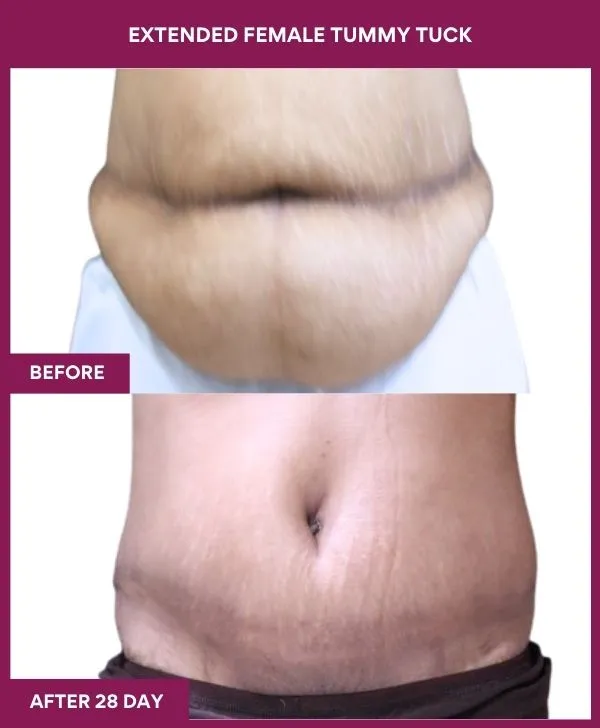 female-extended-tummy-tuck-before-after-results-mumbai-india-patient04-front