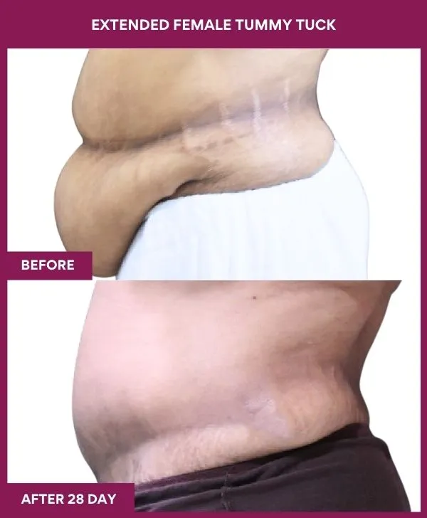 female-extended-tummy-tuck-before-after-results-mumbai-india-patient04-side-left