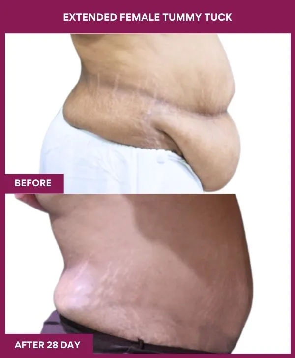 female-extended-tummy-tuck-before-after-results-mumbai-india-patient04-side-right