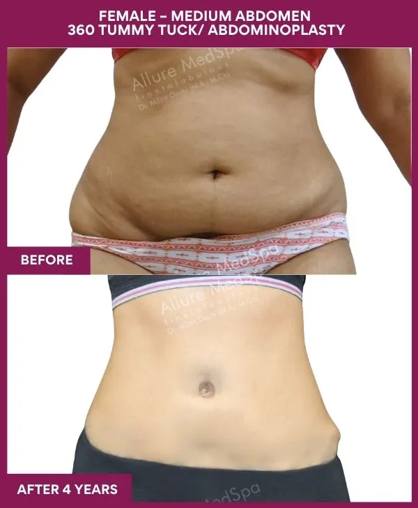 female-medium-360-tummy-tuck-before-after-results-mumbai-india-patient01-front