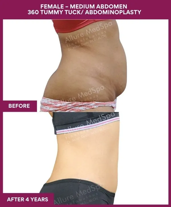 female-medium-360-tummy-tuck-before-after-results-mumbai-india-patient01-side-right