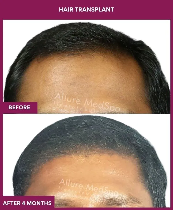 hair-transplant-surgery-before-after-results-mumbai-india-patient01-front