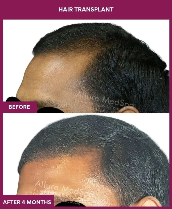 hair-transplant-surgery-before-after-results-mumbai-india-patient01-side-left