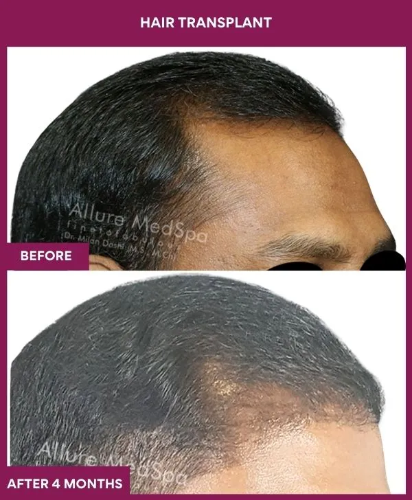 hair-transplant-surgery-before-after-results-mumbai-india-patient01-side-right