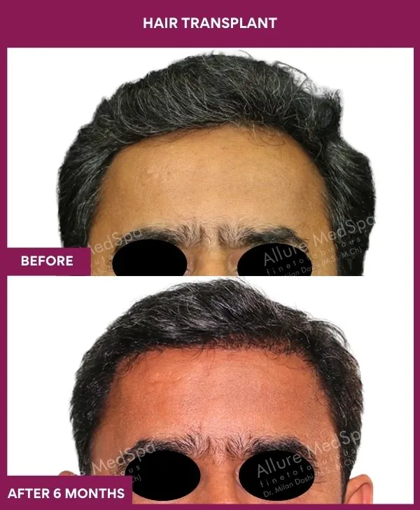 hair-transplant-surgery-before-after-results-mumbai-india-patient02-front