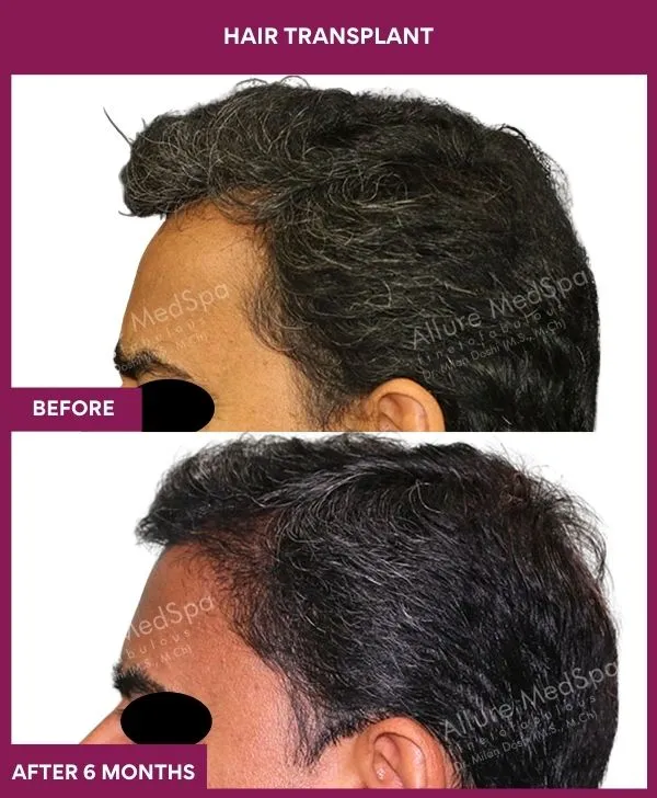 hair-transplant-surgery-before-after-results-mumbai-india-patient02-side-left