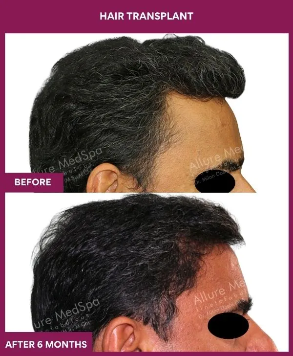 hair-transplant-surgery-before-after-results-mumbai-india-patient02-side-right