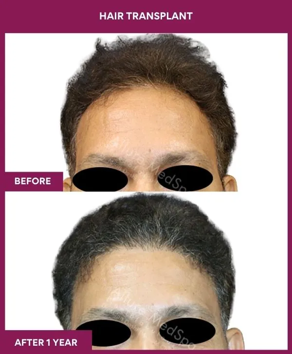 hair-transplant-surgery-before-after-results-mumbai-india-patient03-front