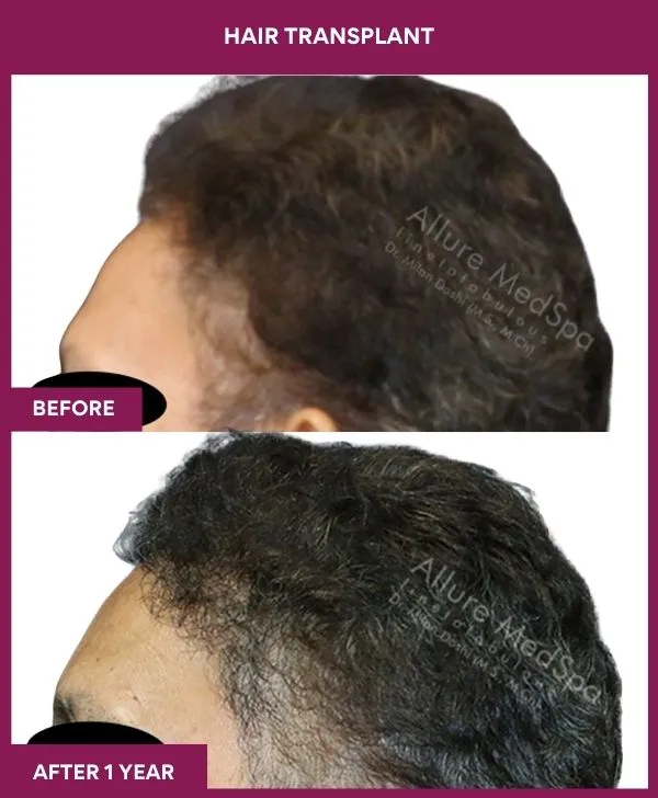hair-transplant-surgery-before-after-results-mumbai-india-patient03-side-left