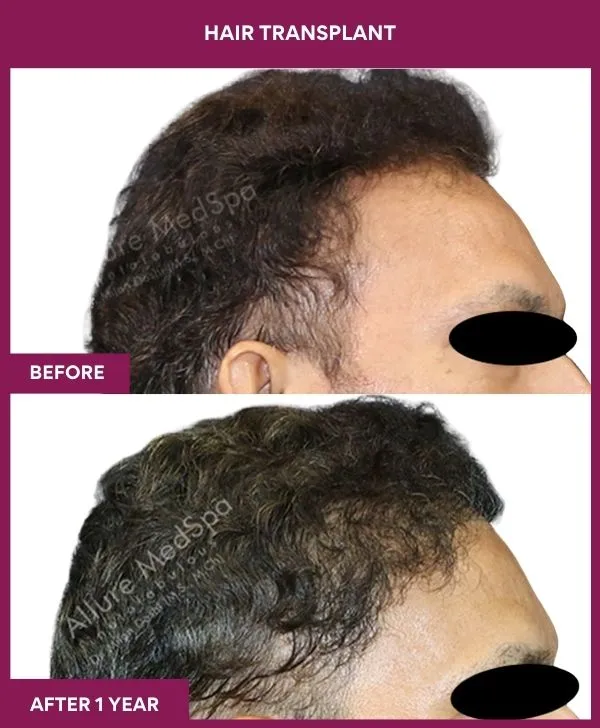 hair-transplant-surgery-before-after-results-mumbai-india-patient03-side-right