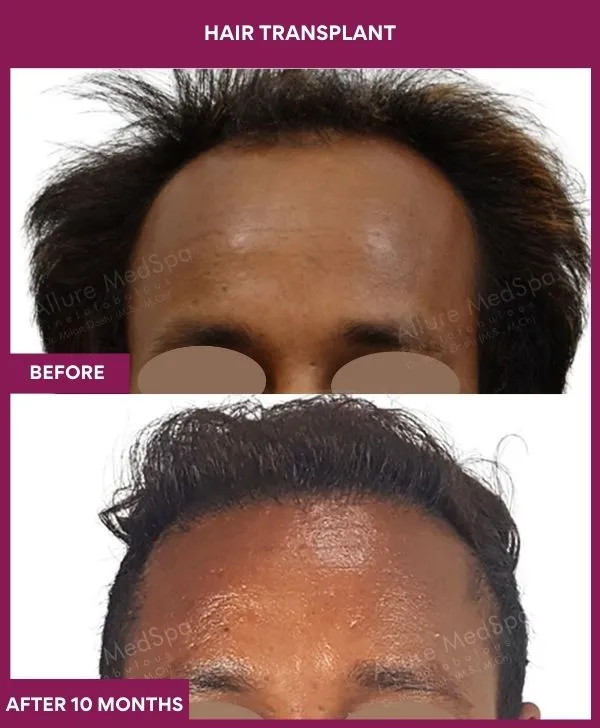 hair-transplant-surgery-before-after-results-mumbai-india-patient04-front