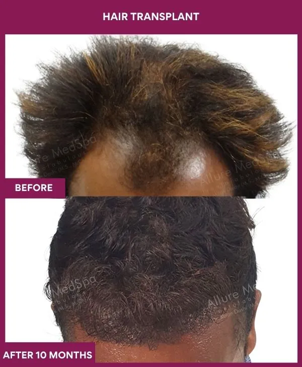 hair-transplant-surgery-before-after-results-mumbai-india-patient04-hairline