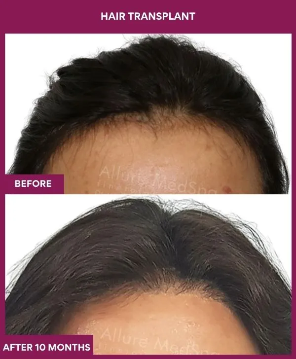 hair-transplant-surgery-before-after-results-mumbai-india-patient05-hairline
