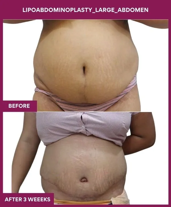 large-female-lipoabdominoplasty-before-after-results-mumbai-india-patient01-front