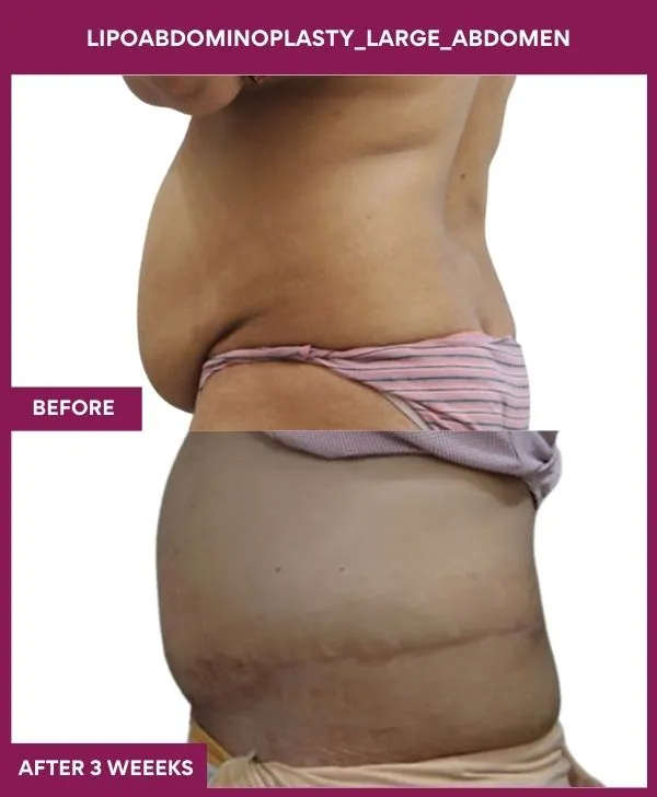 large-female-lipoabdominoplasty-before-after-results-mumbai-india-patient01-side-left