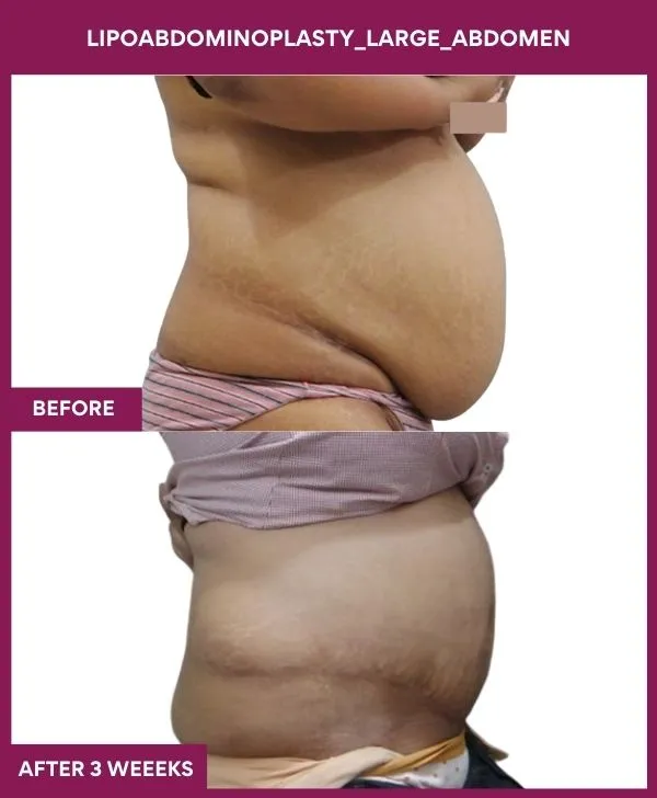 large-female-lipoabdominoplasty-before-after-results-mumbai-india-patient01-side-right