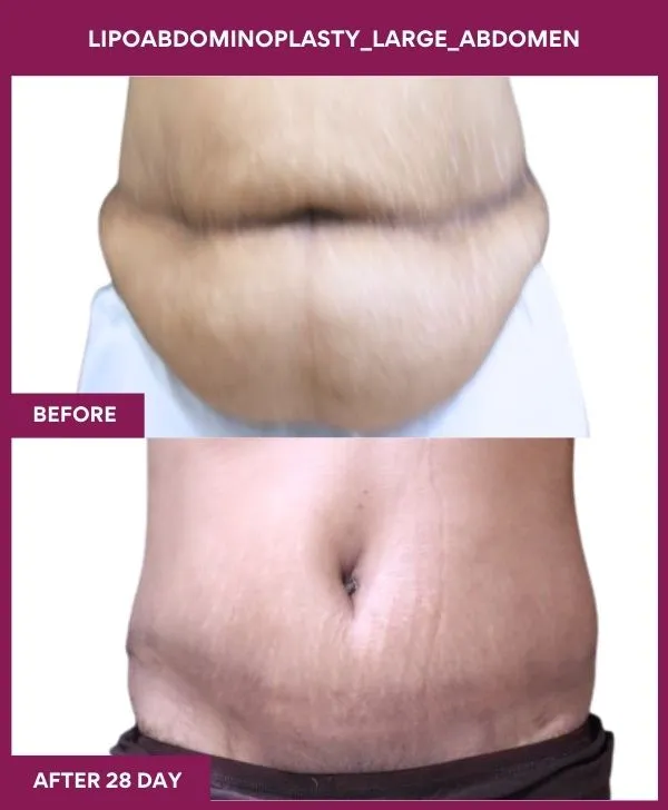 large-female-lipoabdominoplasty-before-after-results-mumbai-india-patient02-front