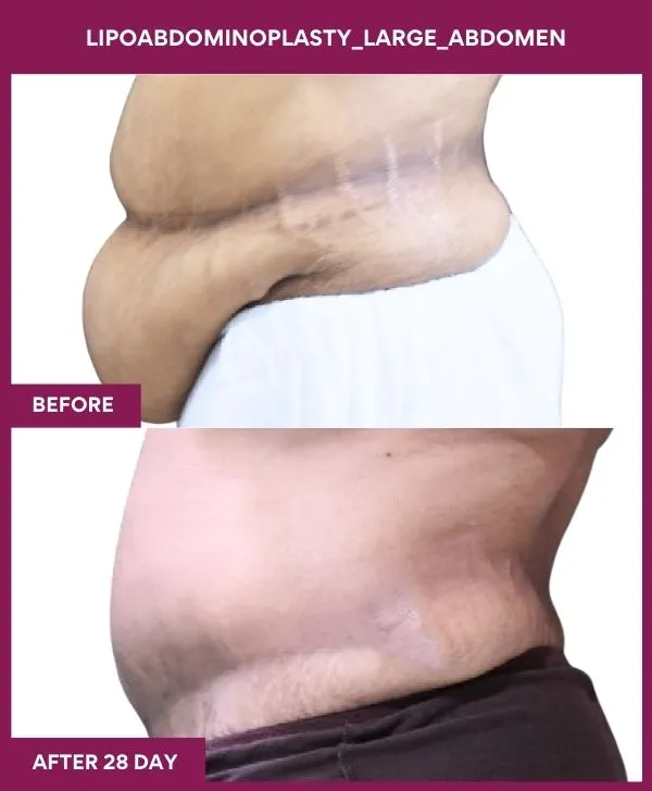 large-female-lipoabdominoplasty-before-after-results-mumbai-india-patient02-side-left