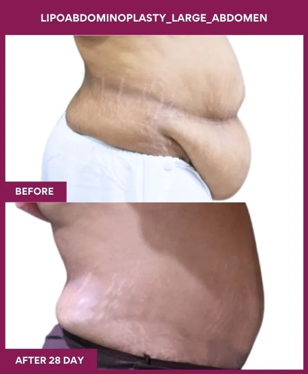 large-female-lipoabdominoplasty-before-after-results-mumbai-india-patient02-side-right