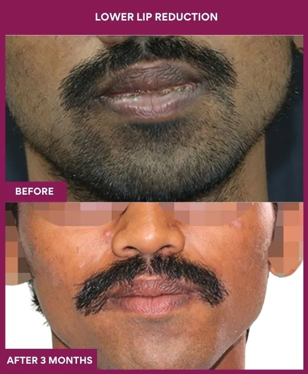 lip-reduction-surgery-before-after-results-mumbai-india-patient01-front