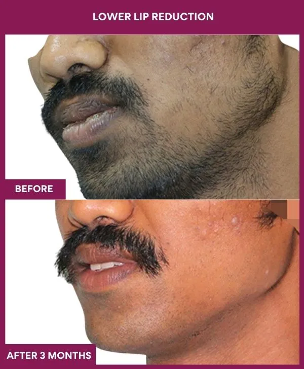 lip-reduction-surgery-before-after-results-mumbai-india-patient01-side-left