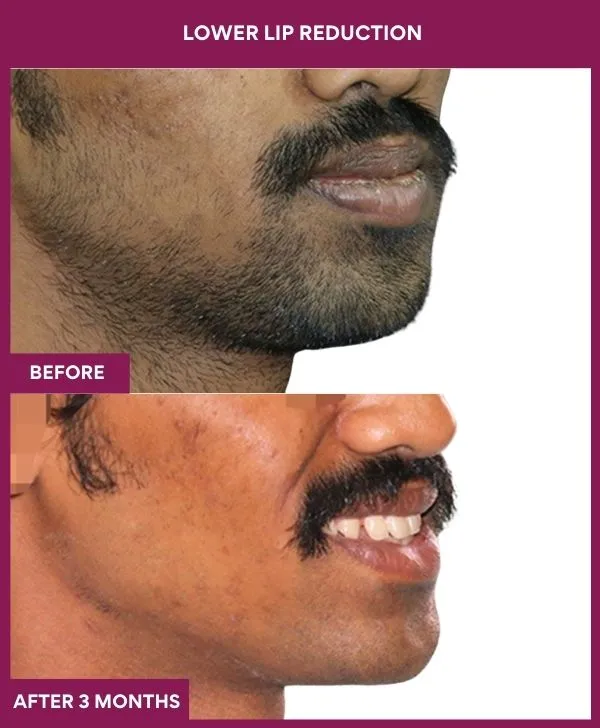 lip-reduction-surgery-before-after-results-mumbai-india-patient01-side-right