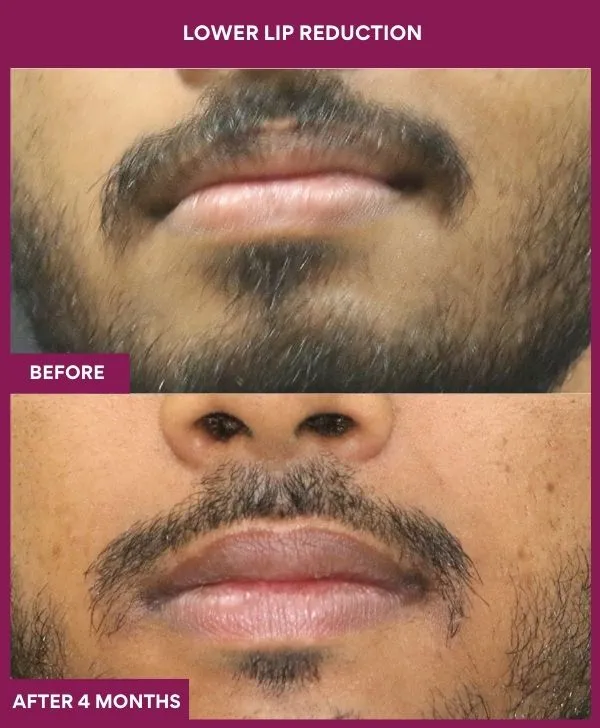 lip-reduction-surgery-before-after-results-mumbai-india-patient02-front