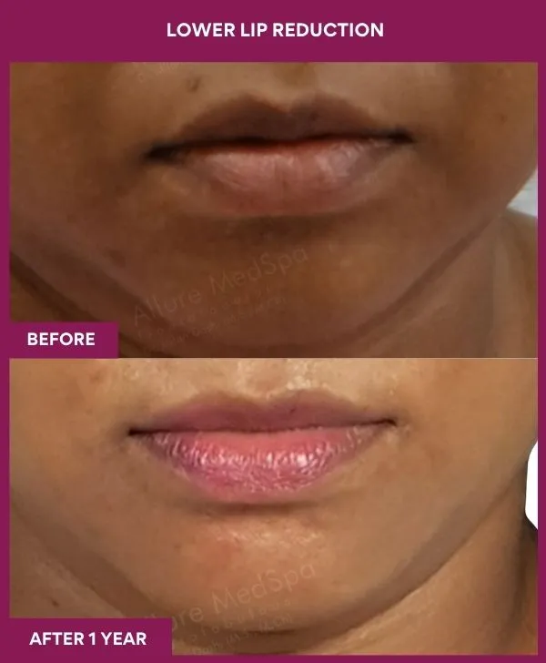 lip-reduction-surgery-before-after-results-mumbai-india-patient03-front