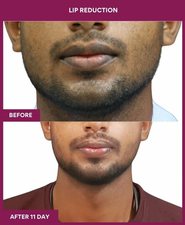 lip-reduction-surgery-before-after-results-mumbai-india-patient04-front