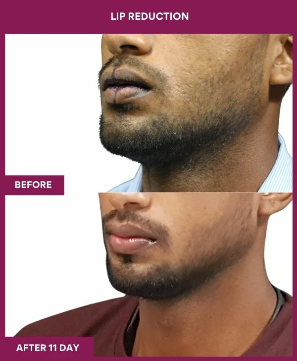 lip-reduction-surgery-before-after-results-mumbai-india-patient04-side-left
