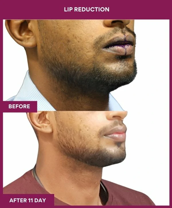 lip-reduction-surgery-before-after-results-mumbai-india-patient04-side-right