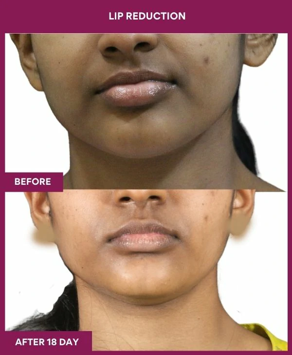 lip-reduction-surgery-before-after-results-mumbai-india-patient05-front