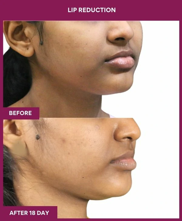 lip-reduction-surgery-before-after-results-mumbai-india-patient05-right