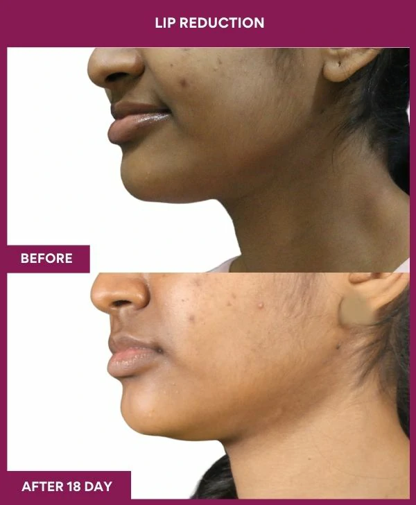 lip-reduction-surgery-before-after-results-mumbai-india-patient05-side-left