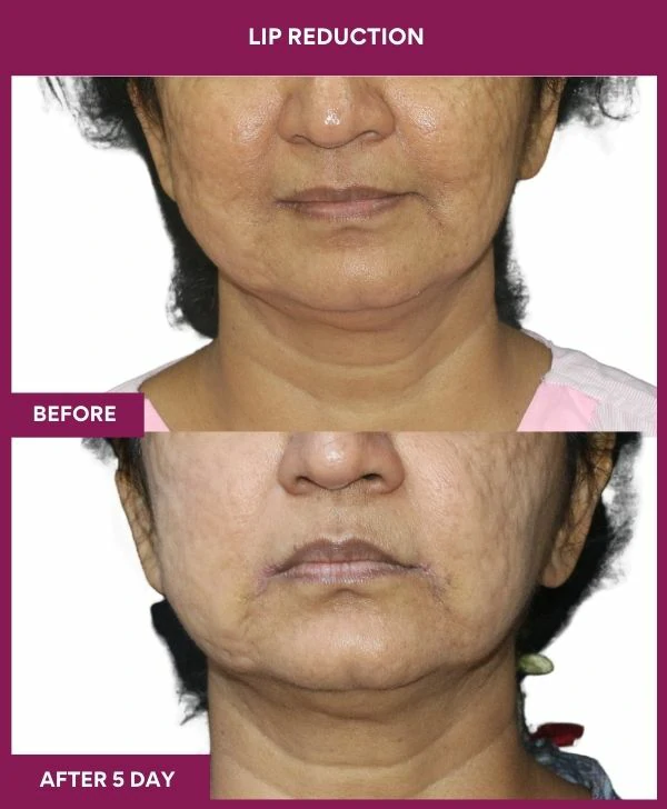 lip-reduction-surgery-before-after-results-mumbai-india-patient06-front
