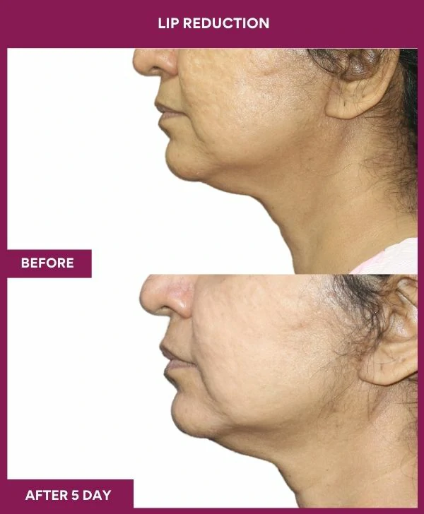 lip-reduction-surgery-before-after-results-mumbai-india-patient06-side-left