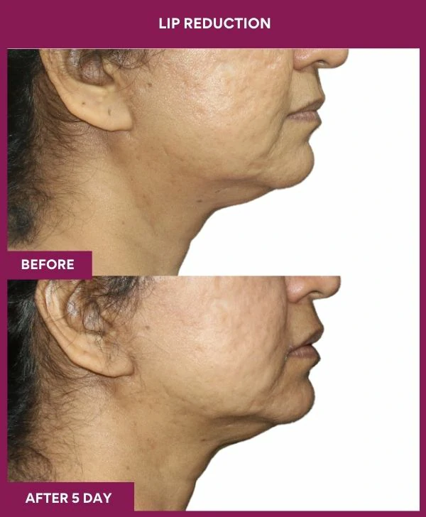 lip-reduction-surgery-before-after-results-mumbai-india-patient06-side-right