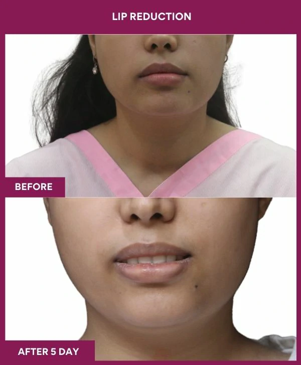 lip-reduction-surgery-before-after-results-mumbai-india-patient07-front