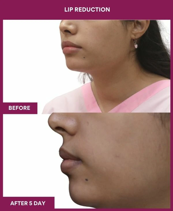 lip-reduction-surgery-before-after-results-mumbai-india-patient07-side-left