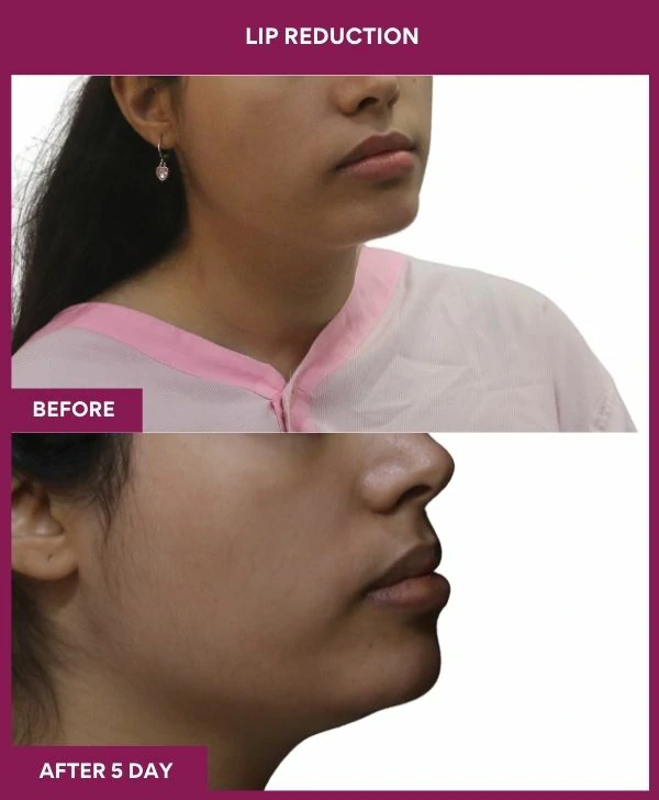lip-reduction-surgery-before-after-results-mumbai-india-patient07-side-right