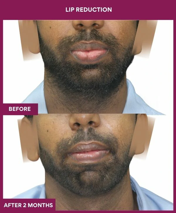 lip-reduction-surgery-before-after-results-mumbai-india-patient08-front