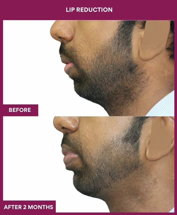 lip-reduction-surgery-before-after-results-mumbai-india-patient08-side-left