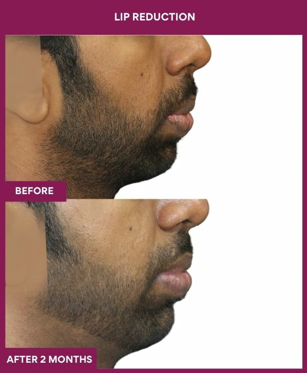lip-reduction-surgery-before-after-results-mumbai-india-patient08-side-right